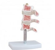 Osteoporoz Kesiti Modeli, Gerek Boy eitleri